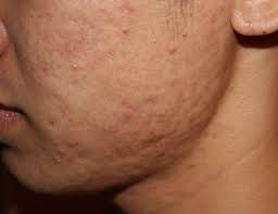 Hypertrophic scars Hypertrophic scars