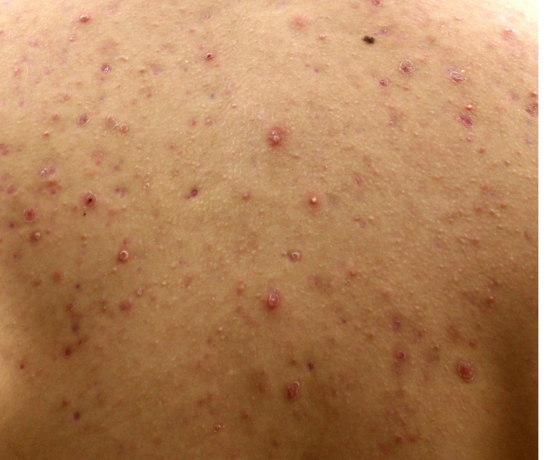 Keloid scars Keloid scars